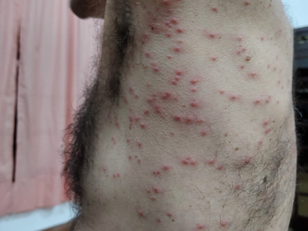 Hundreds of red tick bites cover the side and back of a shirtless man with hairy chest and underarms holding up his arm