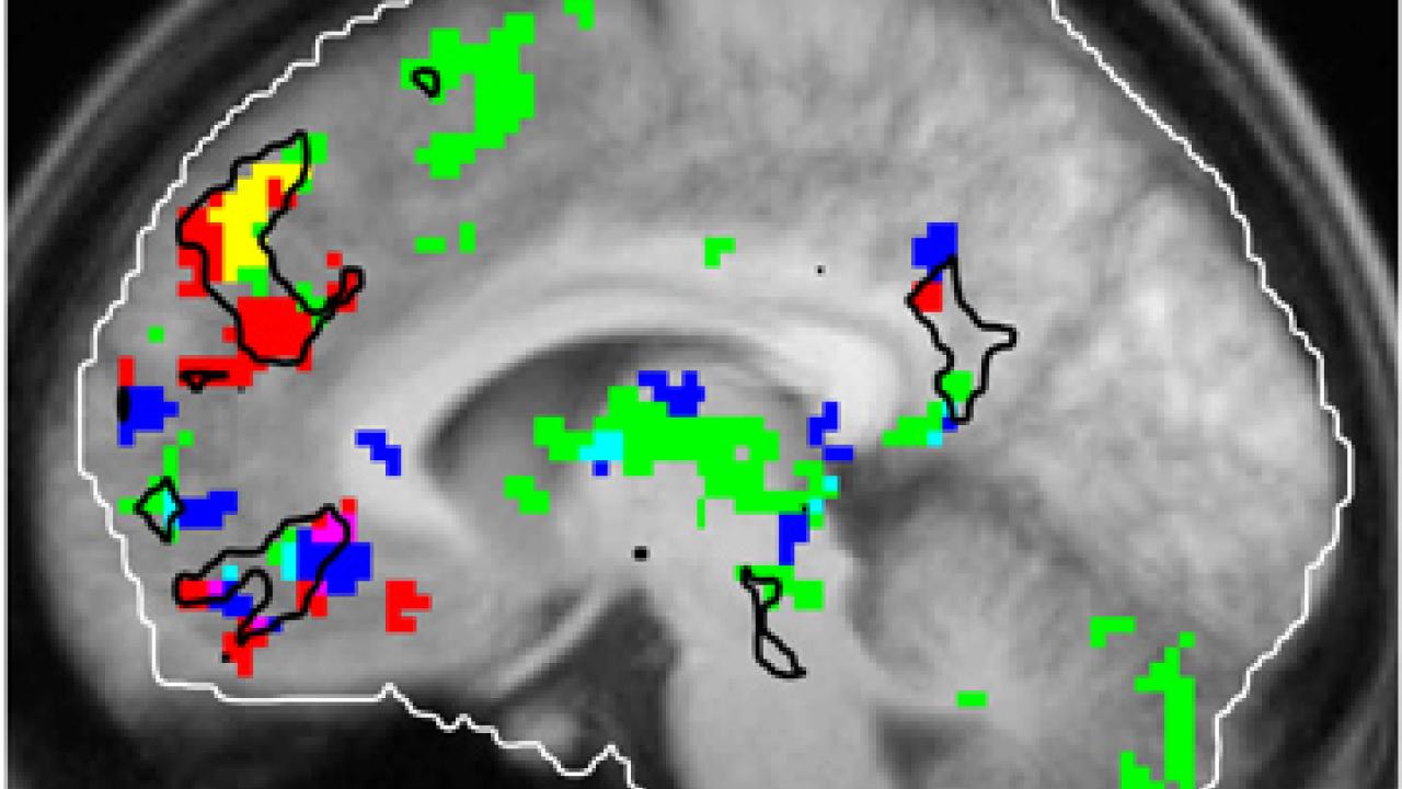 This fMRI brain scan shows areas that respond to familiar tunes, salient memories and music that is perceived as enjoyable. 