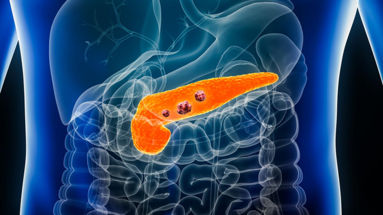 Graphic illustration of a human pancreas. Here the pancreas is orange inside a human body shown in blue with other organs nearby. (Getty)
